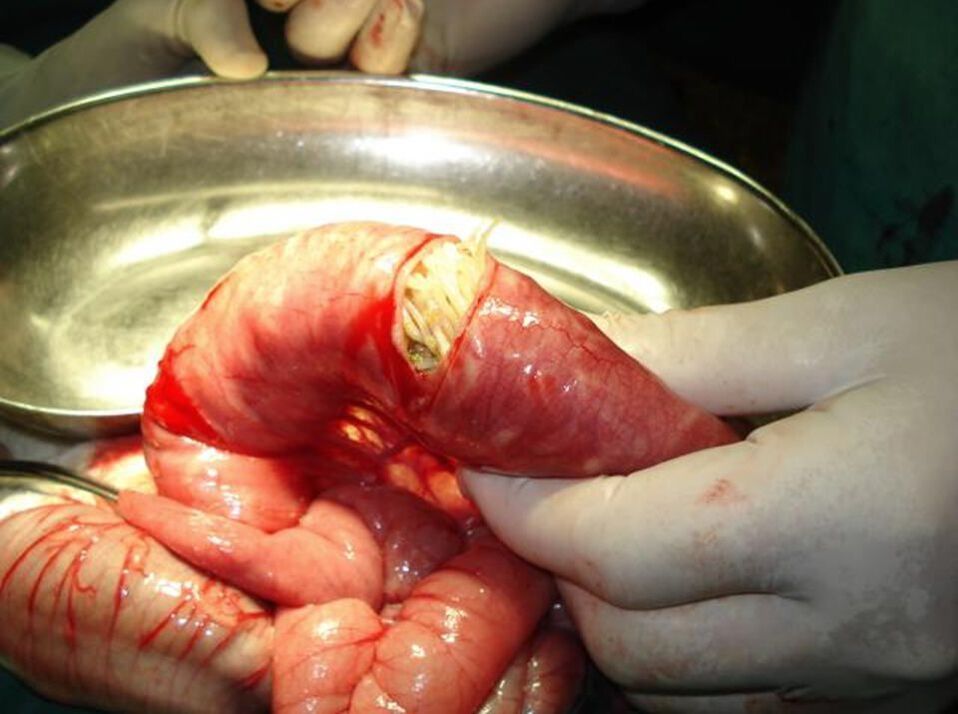 Lombrices intestinales en el intestino humano