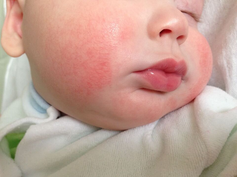 Un signo de gusanos en un niño es la urticaria alérgica. 